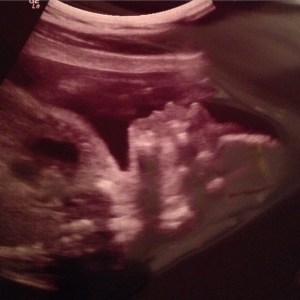 ultrasound